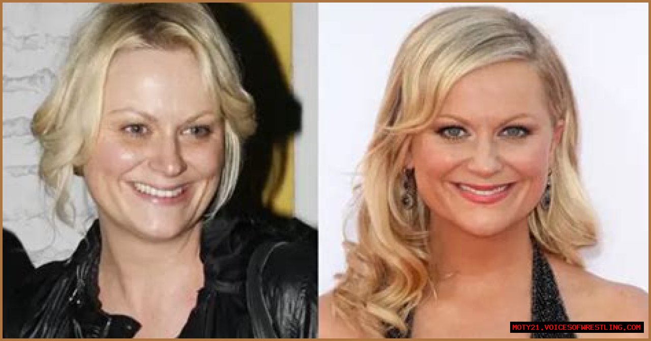 Amy Poehler Plastic Surgery Before and After Botox Injections