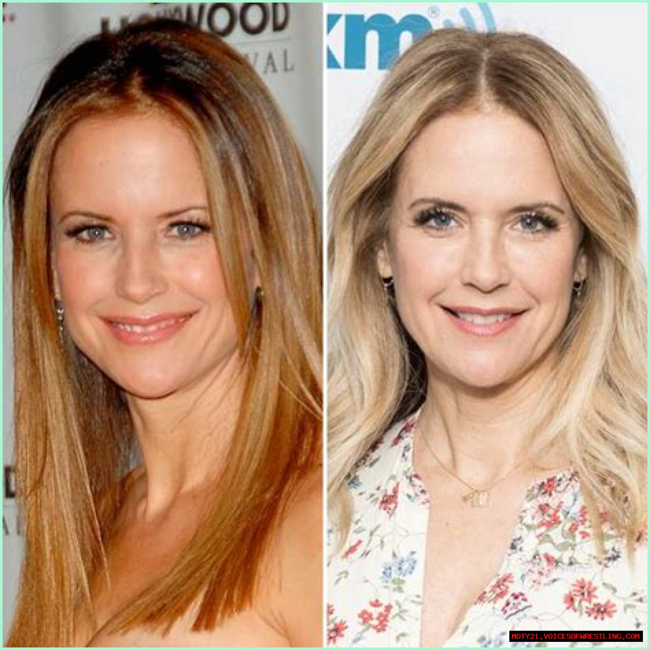Kelly Preston Plastic Surgery Before and After