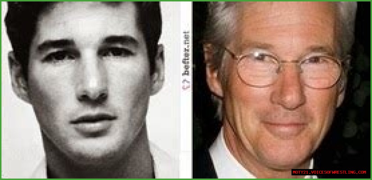 Richard Gere Plastic Surgery Before and After