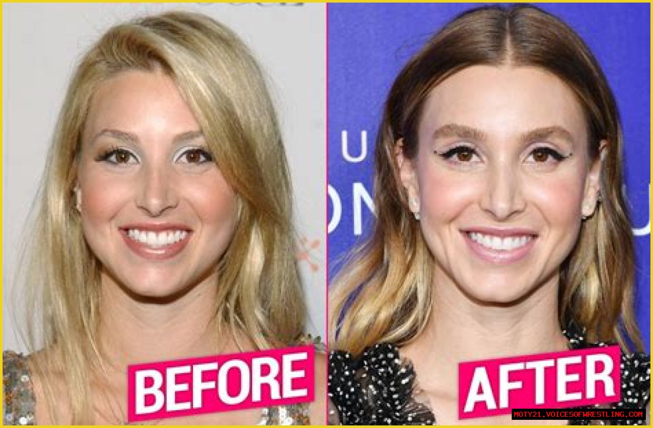Whitney Port Plastic Surgery Before and After